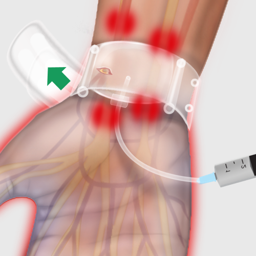 Inadequate Hemostatic Effect